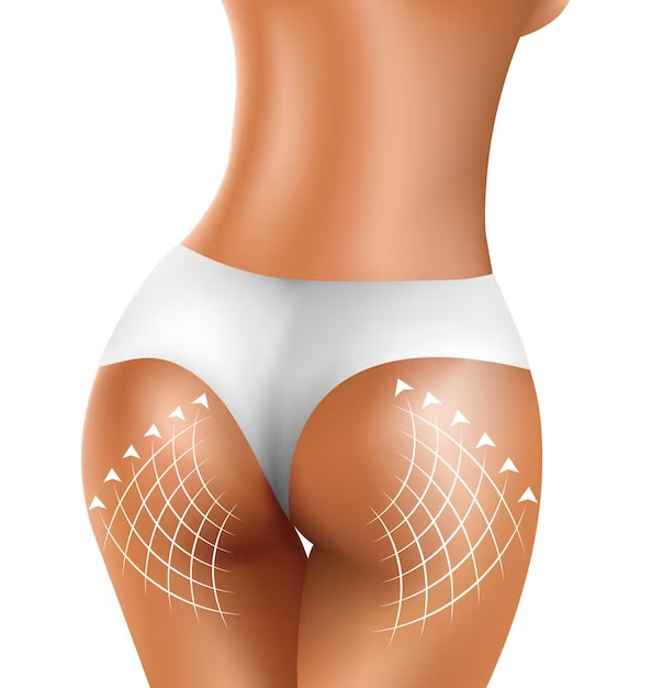 gluteoplatia foto 2